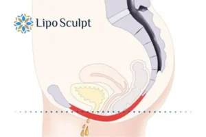 Pelvic Floor Chair Therapy 1 Pelvic Floor Chair Therapy Coalville to treat incontinence.